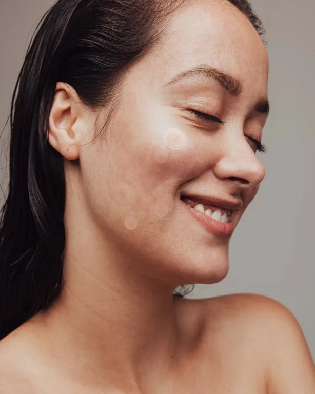 Mujer sonriente con parches hidrocoloides transparentes aplicados en la mejilla