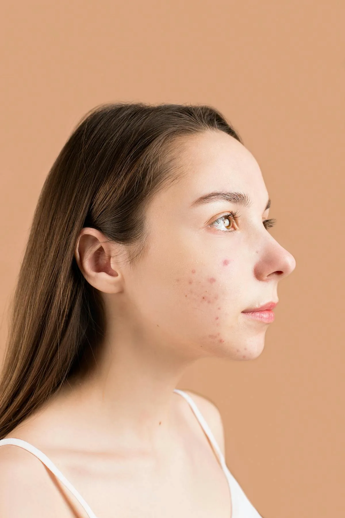 Adolescente con acne en perfil, primer plano