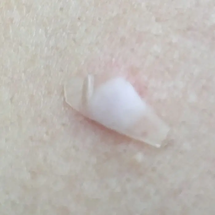 Parche hidrocoloide para acne