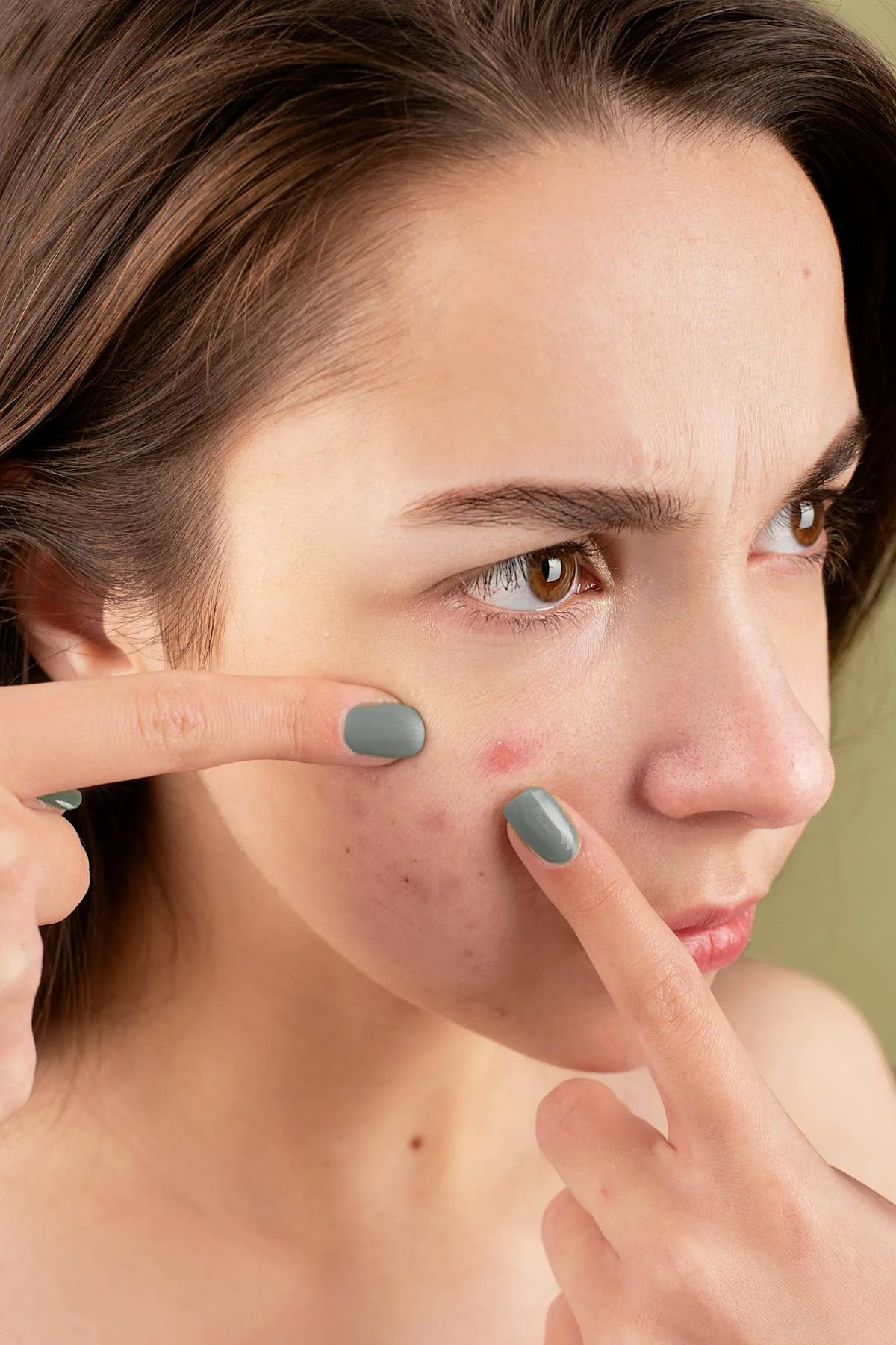 Mujer tratando piel con acne de cerca